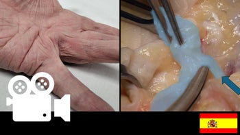 Aponeurectomia parcial: Enfermedad de Dupuytren