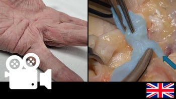  Dupuytren’s disease - Aponeurectomy