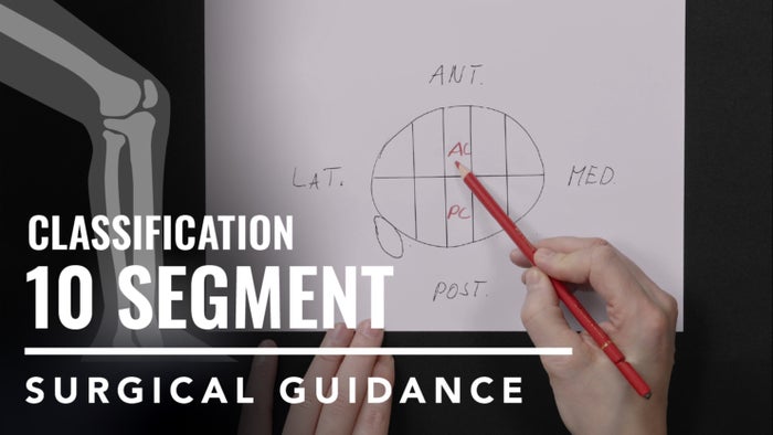 Tibial Plateau Fractures: Ten-Segment Classification
