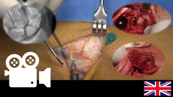 Pseudoarthrosis of the scaphoid bone - 2,3 Intercompartmental Supraretinacular Artery Pedicled Vascularized Bone Graft for Scaphoid Nonunions