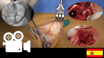 Pseudoartrosis del escafoides carpiano: 2,3 Injerto óseo vascularizado con pedículo de arteria supraretinacular intercompartimental