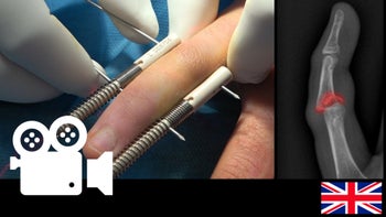 Complex fracture dislocation of the Proximal Interphalangeal Joint - Dynamic external fixator