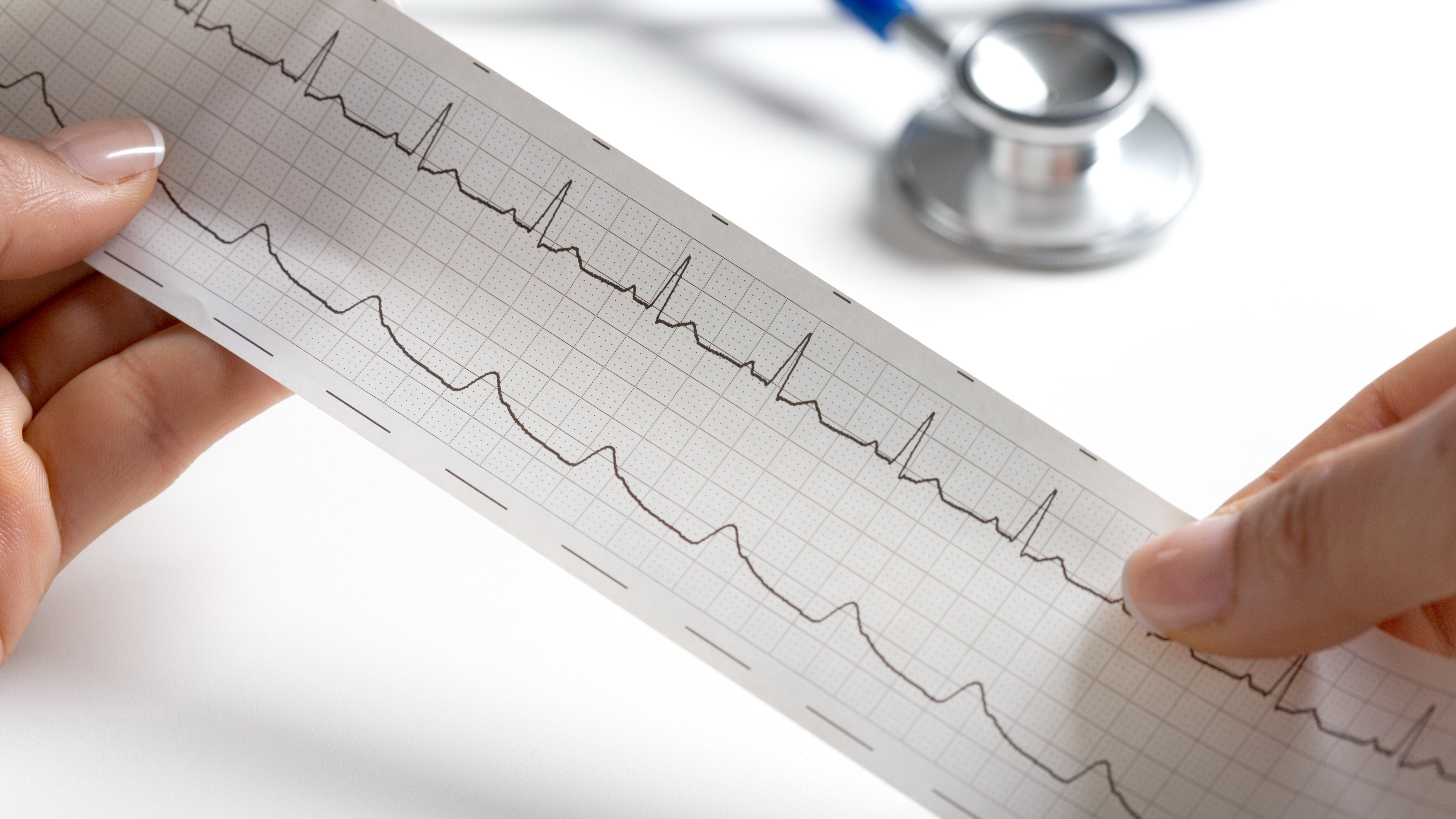 Modificările morfologice ale EKG