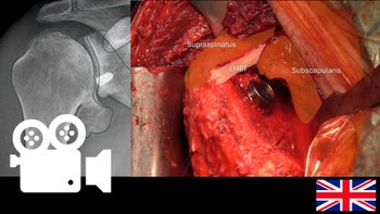 Hemiarthroplasty for Shoulder Osteoarthritis
