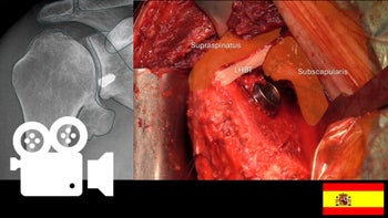 Hemiartroplastia por artrosis glenohumeral