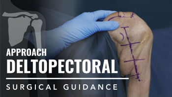 Deltopectoral Approach to the Proximal Humerus