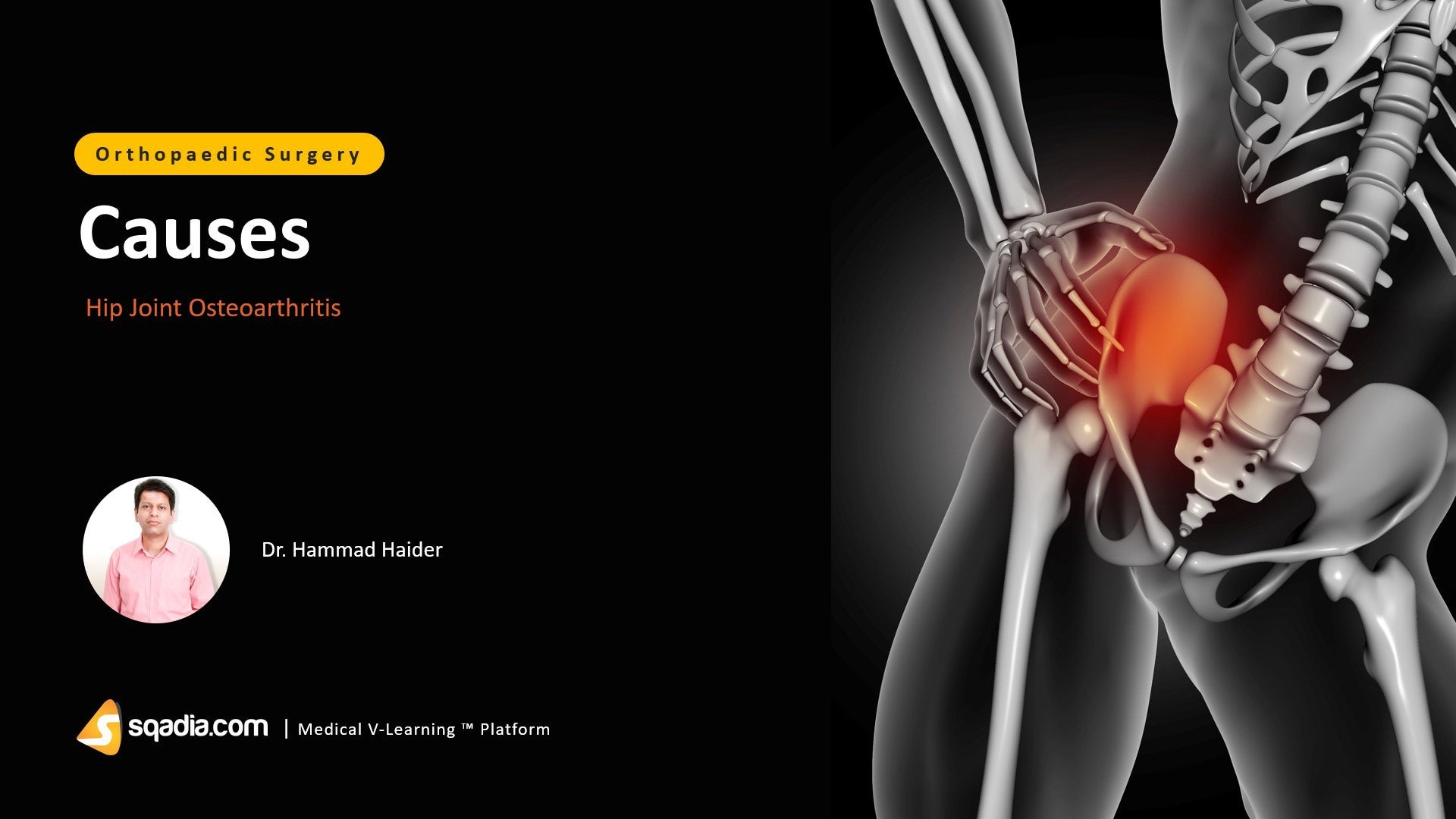 Hip Joint Osteoarthritis Causes