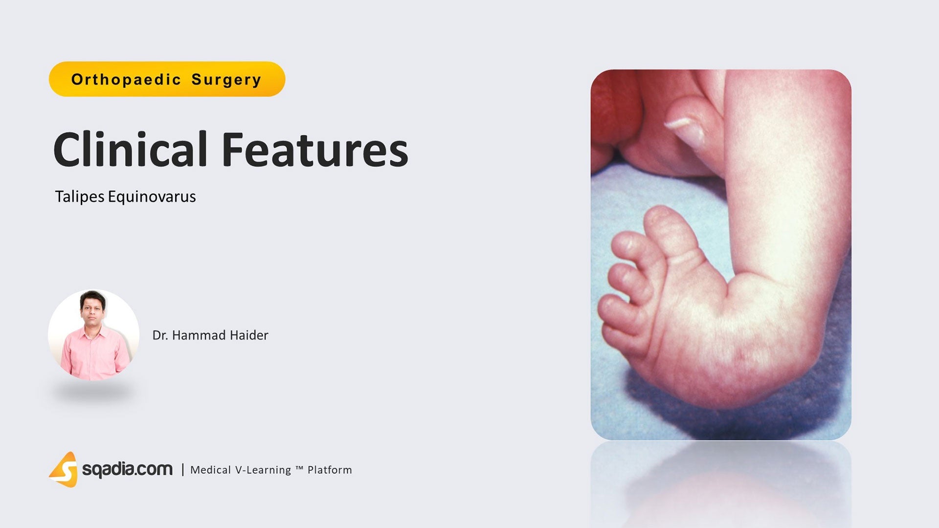 Talipes Equinovarus Clinical Features